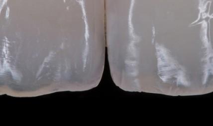 Реставрации фронтальных зубов