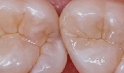 Реставрация жевательных зубов. Структура оттенков